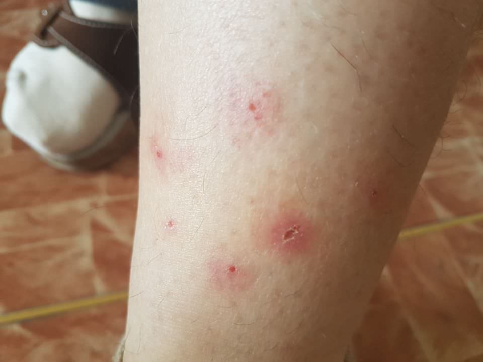 Jak Vypada Stipnuti Od Stenice () Jak Vypada Stipnuti Od Stenice